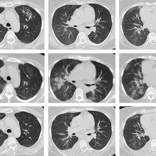 Neumonía intersticial descamativa Secciones de TC Áreas de atenuación Download Scientific