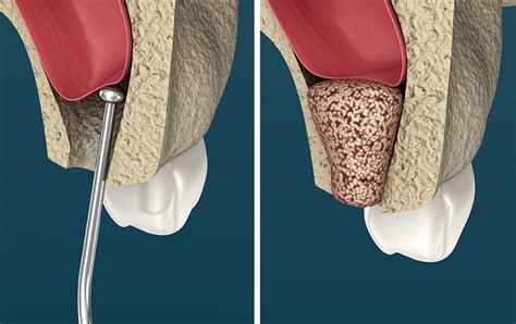 Sinus Lifts Dr Zeb McNamara Oral Dental Implant Maxillofacial Surgeon Brisbane