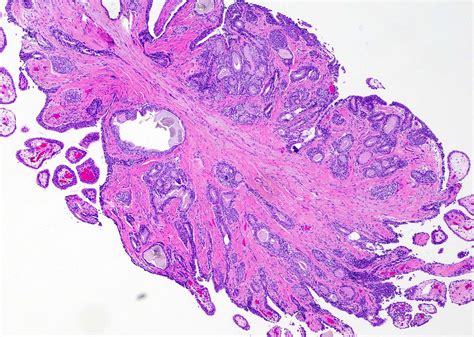 Pathology Outlines Urethral Polyp
