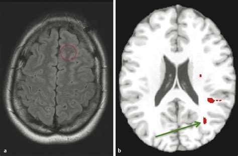 Diffusion Imaging For The Assessment Of Traumatic Brain Injury