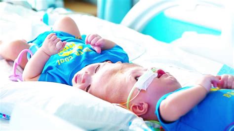 New Life Apart Conjoined Twins Separated Undergo Surgery As