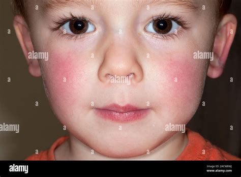 Slapped Cheek Disease Close Up Of The Reddened Face Of A 4 Year Old