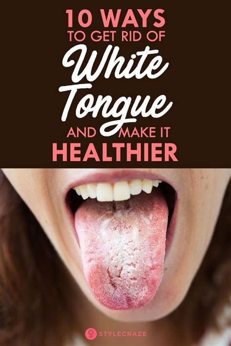 10 Ways To Get Rid Of White Tongue And Make It Healthier Tongue