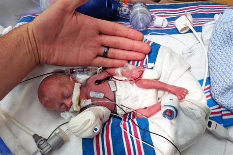 Miracle Baby Born At 11 Ounces Headed Home After 9 Months