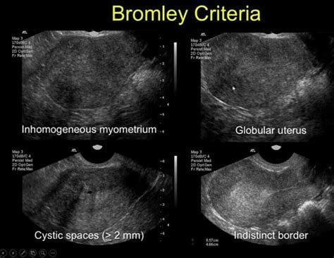 Learn about endometriosis, including possible treatments for this condition that causes pain and sometimes infertility. ADENOMYOSIS - #Adenomyosis | Ultrasound sonography ...