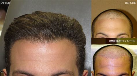 Fue Hair Transplantation Before And After Pictures Dr Turowski Plastic Surgery Chicago