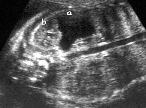 Accuracy Of Antenatal Fetal Ultrasound In The Diagnosis Of Duplex