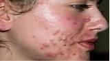 Home Remedies For Rosacea Pimples Pictures