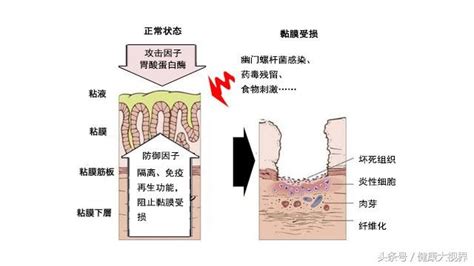 胃粘膜分层图胃粘膜分层5层示意图胃黏膜第2页大山谷图库