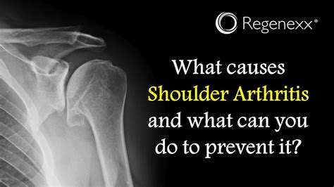 It may be worsened by looking up or down for a long time, or by activities where the neck is held in the same position for. What Causes Shoulder Arthritis? - Regenexx®
