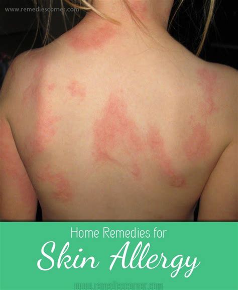 The 25 Best Skin Allergy Treatment Ideas On Pinterest Homeopathic