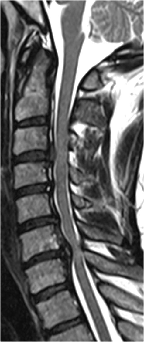 Preoperative Mri Of The Cervical Spine T2 Sagittal Sequence