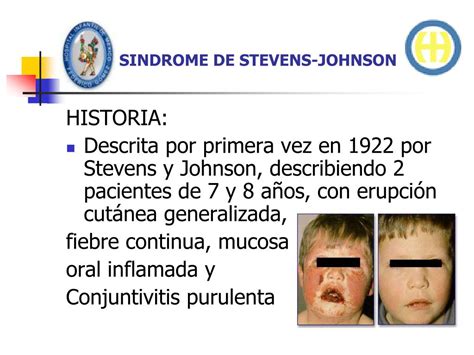 Ppt Sindrome De Stevens Johnson Powerpoint Presentation Free