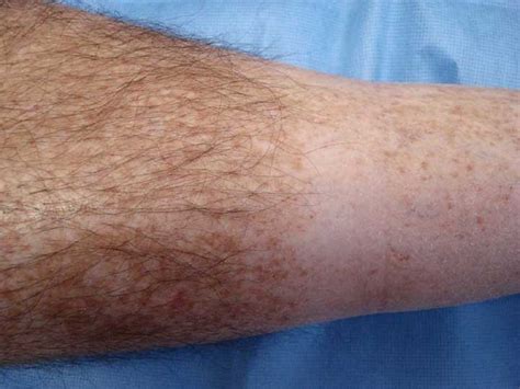 virtual grand rounds in dermatology primary care perplexing dermatosis of legs
