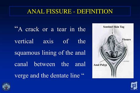 Is A Fissure A Sign I Need A Dental Implant
