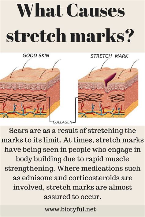 Pin On Stretch Marks