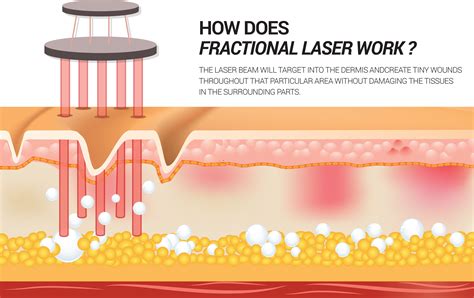 Fractional Laser Drtony Beauty Expert