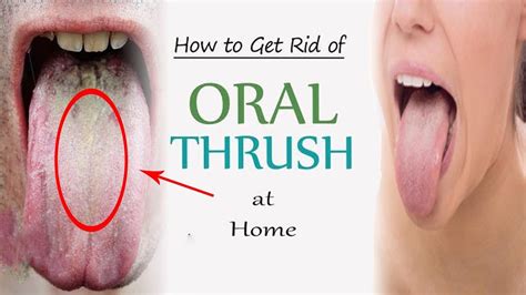 How To Get Rid Of Oral Thrush Fast Home Remedies For Oral Thrush
