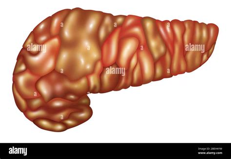 Illustration Of An Inflamed Pancreas Pancreatitis Pancreatitis May