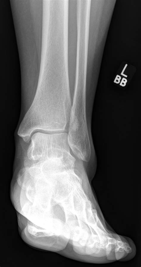 Chaput Tubercle Fracture Image