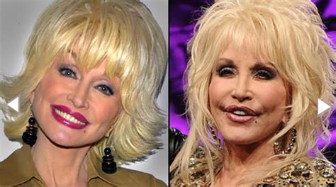 Dolly Parton Plastic Surgery She Has Been Bold Enough To Confirm Some