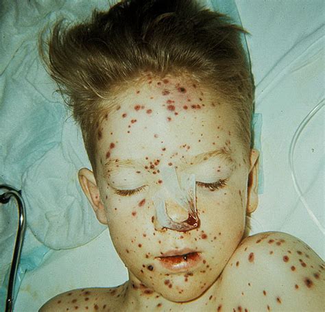 Commonly starts on the chest and may spread to any part of the body. Chickenpox on Face Pictures - 15 Photos & Images ...