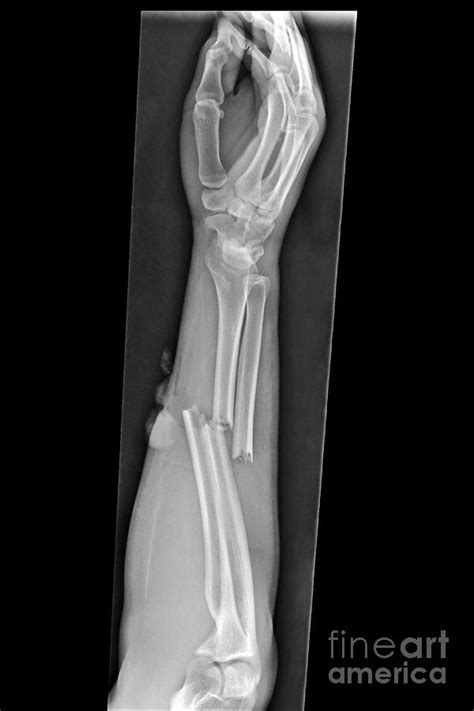 Broken Arm X Ray By Science Photo Library