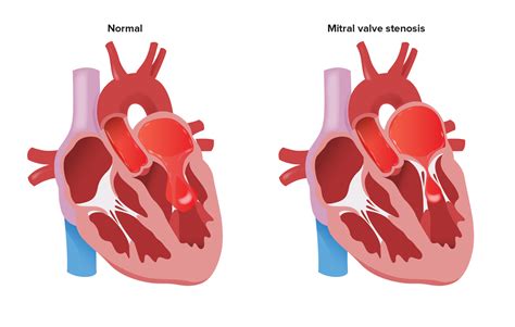 Mitral Stenosis Concise Medical Knowledge
