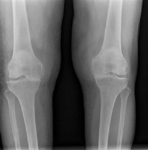 Bilateral Knee X Ray Showing Osteoarthritis Yes Ouch