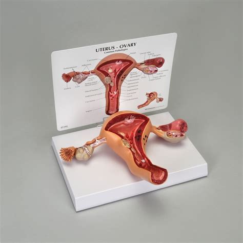 Gpi Anatomicals® Human Uterus And Ovary Pathology Model Carolina