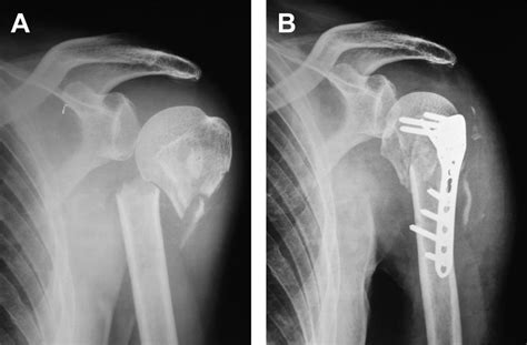 A Preoperative Radiograph Showing Fracture Of Proximal Humerus B Hot Sex Picture