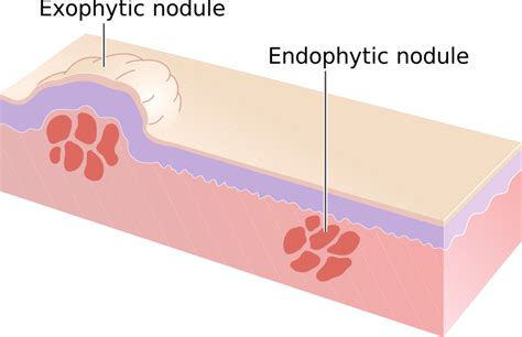 Fichiernodules Exophytiques Et Endophytiques Schémasvg — Wikimedica