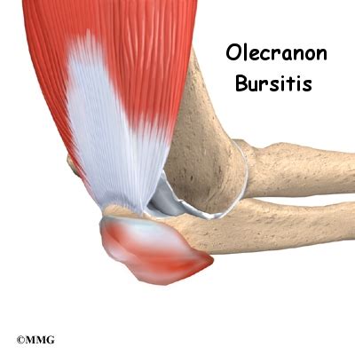 Use these proven exercises to build your elbows' strength, health, and mobility. Olecranon Bursitis | eOrthopod.com