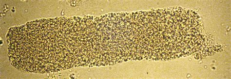 They form in the distal convoluted tubule and collecting ducts of nephrons, then dislodge and pass into the urine, where they can be detected by microscopy. Granular casts