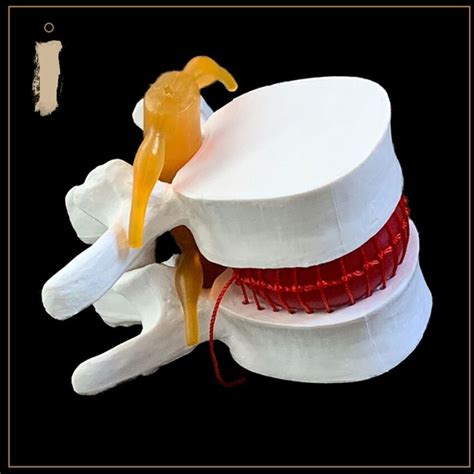 Anatomical Human Lumbar Vertebrae Degenerative Lumbar Disc Herniation Demonstration Model Human