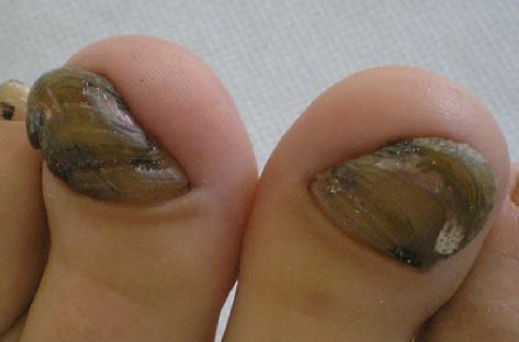 Foot fungus can include symptoms such as burning, itching, cracking, or peeling on the foot or between the toes, or it can manifest in the toenails through thick, discolored nails and pain. Green coloration of the toe nail. | Download Scientific ...