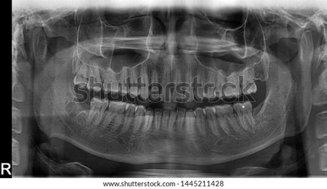 Panoramic Radiograph Showing Lingual Nerve Damage Stock Photo