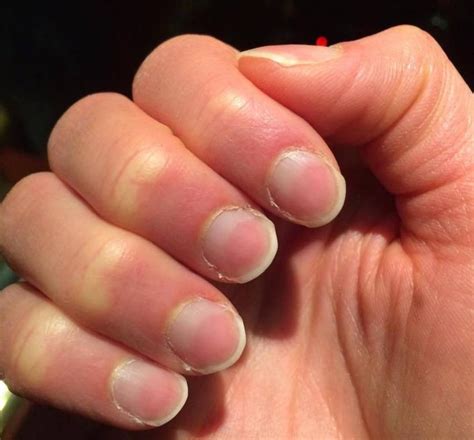 Nail abnormalities: Causes, symptoms, and pictures | Image 