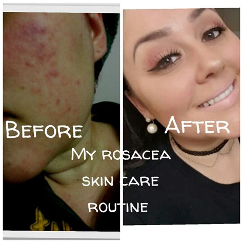 Rosacea Skin Care Routine