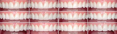 How To Choose The Best Veneers Tips And Proven Techniques