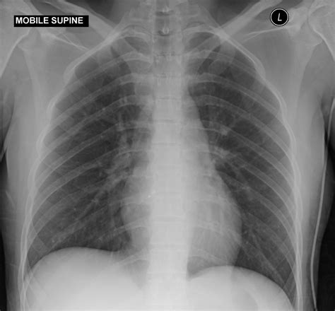 Patent Foramen Ovale Pfo Closure Device Radiology Case