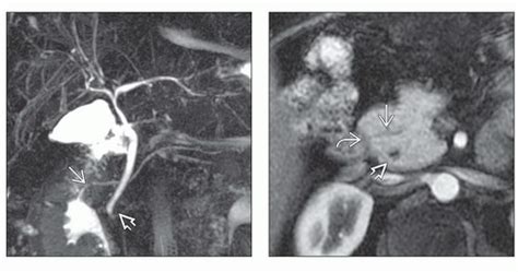 Pancreas Divisum Radiology Key