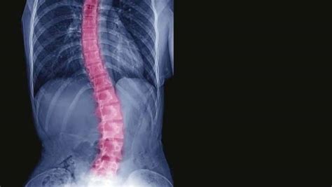 Scoliosis Types Symptoms Causes Treatments Global Tre