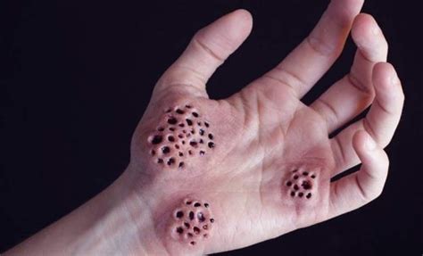Trypophobia Symptoms Causes And Treatments Exploring Your Mind