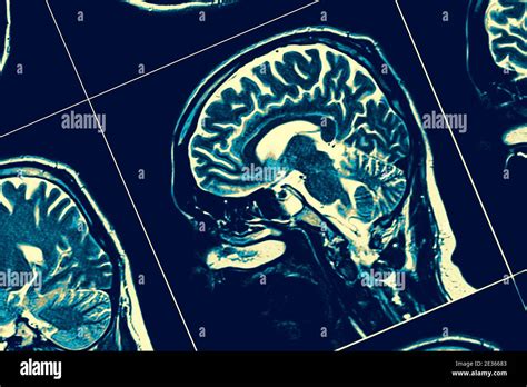 Sagittal Section Of The Human Brain Hi Res Stock Photography And Images