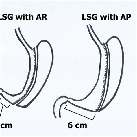 Illustration Of Sleeve Gastrectomy With And Without Antral Preservation
