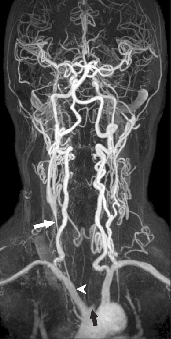 Magnetic Resonance Angiogram Shows Stenosis Of The Right Common Carotid