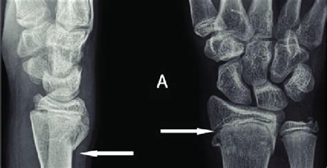 Buckle Fracture