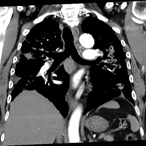 Silicosis With Progressive Massive Fibrosis Pneumothorax Image