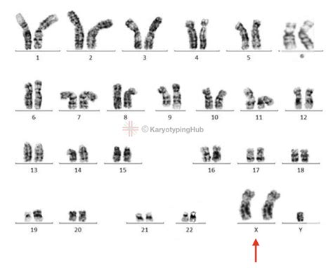 A Karyotype Of Klinefelter Syndrome Explained Karyotypinghub